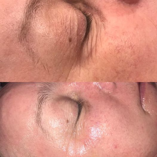 Medi+ i’Tx Peptide Eye & Lip Complex
