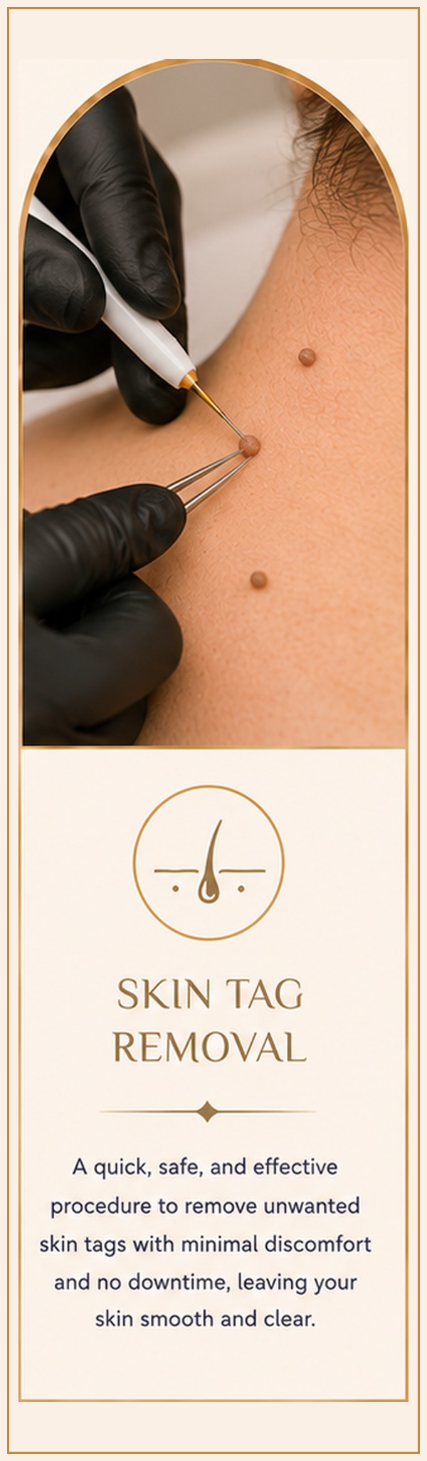 Skin Tag Removal (Plasma Pen)
