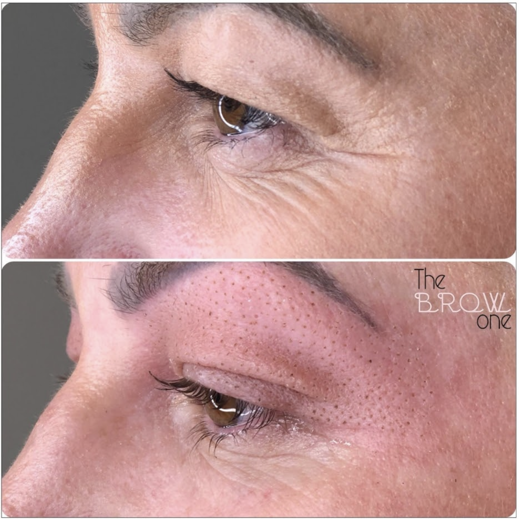 Plasma Pen Before and After